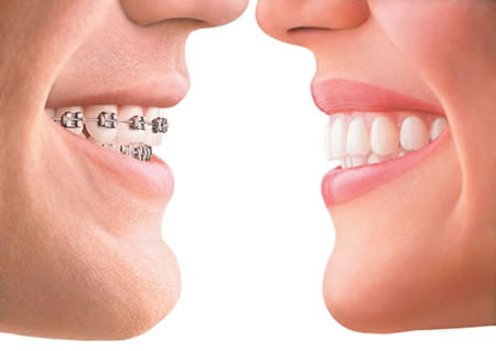 invisalign