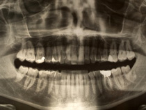 X-Rays Dental X-Rays